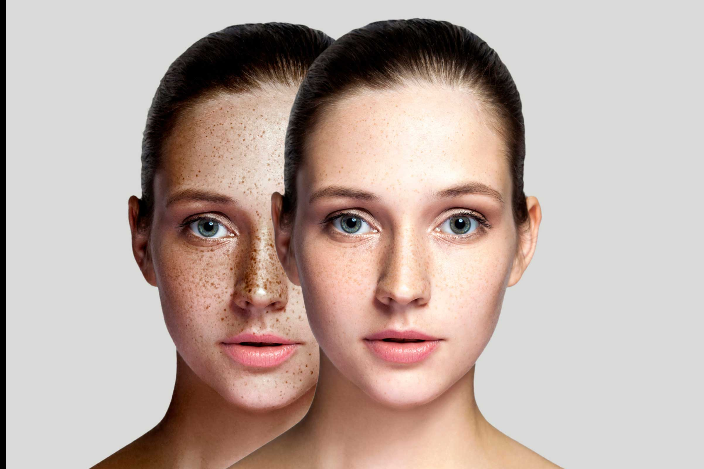 Clinical Application of 1550nm Non ablative Lattice Laser