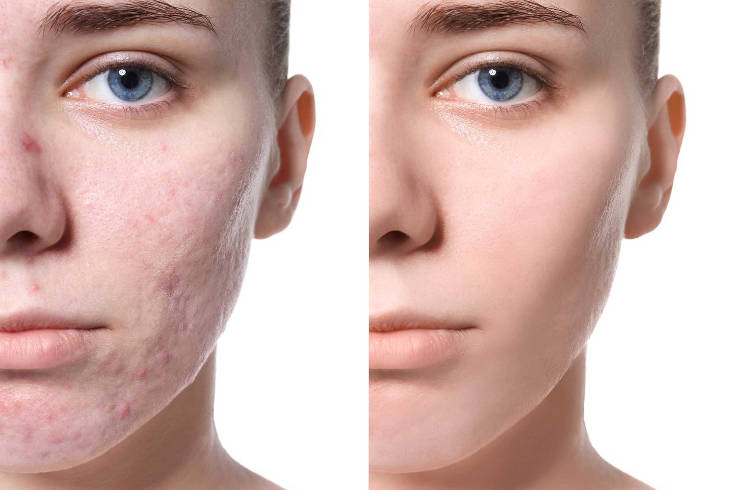 100W Long Pulse 10600nm CO2 Fractional Laser: Advancing Precision in Skin Resurfacing